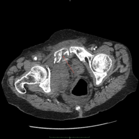 CT demonstrating pubic rami fracture