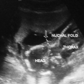Antenatal sonography fetal head and neck longitudinal section