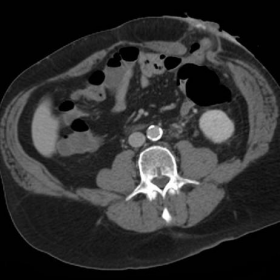 Preoperative contrast-enhanced CT