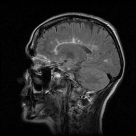 MRI sagittal FLAIR