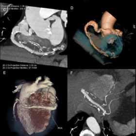 Cardiac computed tomographic examination – VRT and MIP reconstructions