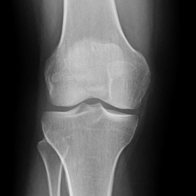 AP and lateral knee X-ray