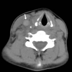 Initial multidetector CT of neck and thorax