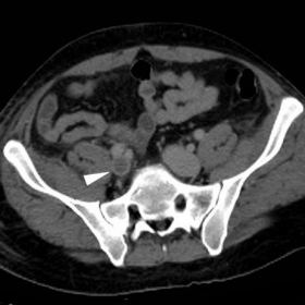 Initial contrast-enhanced multidetector CT - venous images