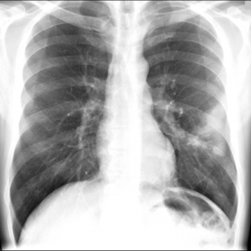 Posteroanterior chest radiograph