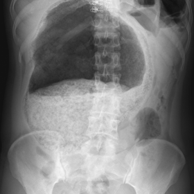 Erect abdominal plain radiograph