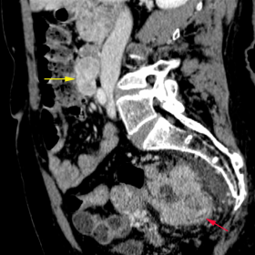 CT image of both GIST and Colorectal Carcinoma