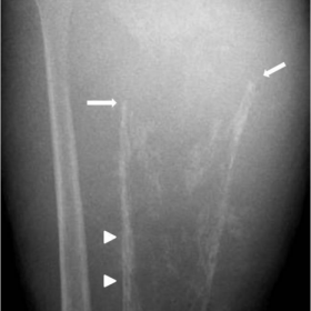 Figure 1.Anteroposterior and lateral right leg radiograph at presentation.