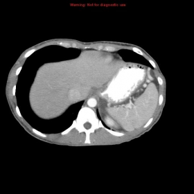 Axial CT showing pancreatic pseudocyst with drainage catheter