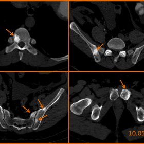 CT images in the axial plane without iv contrast medium