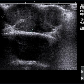 Ultrasound of the occipital region