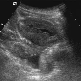 Ultrasound demonstrating circumferential thickening of the bladder wall