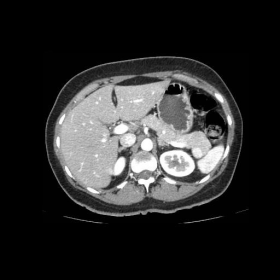 Axial CT scan during hepatic arterial phase.
