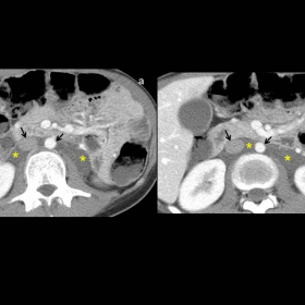 Axial MDCT images