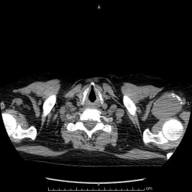 Chest CT findings