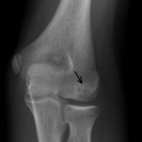 Plain radiograph of the left elbow in AP position