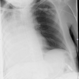 Chest radiograph 1