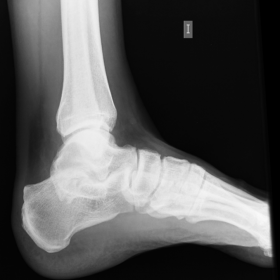 Lateral ankle radiograph