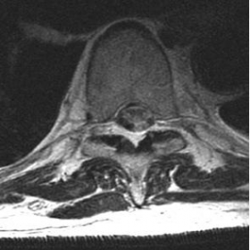 MRI of the dorsal spine: Axial FSE T2