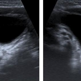 Ultrasound pelvic region