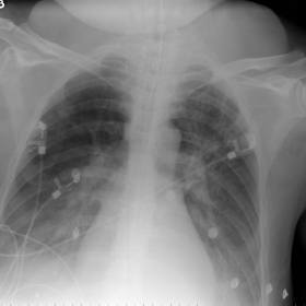 AP chest X-ray