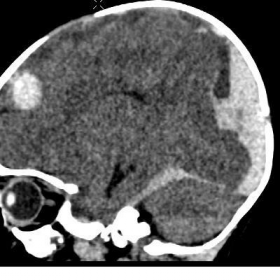 Sagittal CT-HEAD view of 3-month infant presenting to the ED