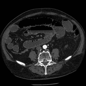 CT abdomen - axial images