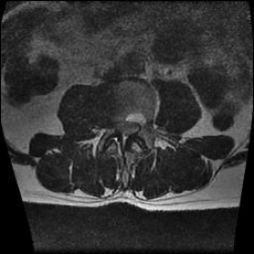 Axial T2 weighted MRI of the lumbar spine