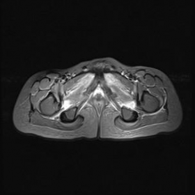 MRI STIR axial image of upper thigh