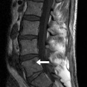 Early lumbar spine MRI (obtained at another facility)