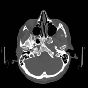 Axial skull base CT images