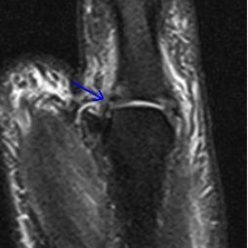 MRI thumb Coronal PDFS
