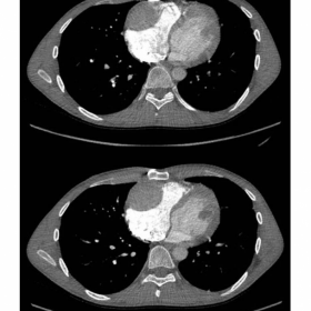 Pulmonary angiography CT