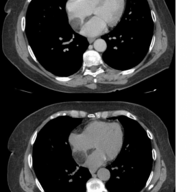 Multislice computed tomography showed lipomatosis of the interatrial septum