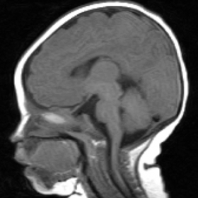 T1 weighted MRI image