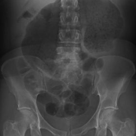 Abdominal Plain X-ray,  supine AP (anterior-posterior) projection