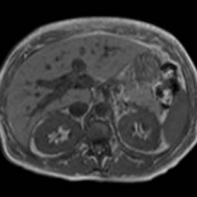 Unenhanced abdominal MRI