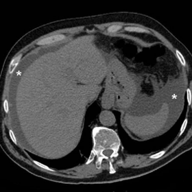 Initial unenhanced multidetector CT (MDCT)