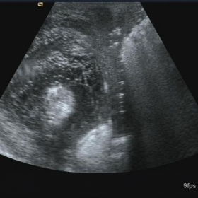 Scrotal Ultrasound