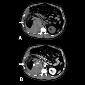 Axial CT unenhanced (A) and contrast-enhanced (B)