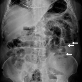 Plain abdomina radiographs