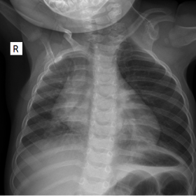 Chest X-ray consistent with left shoulder Sprengel deformity