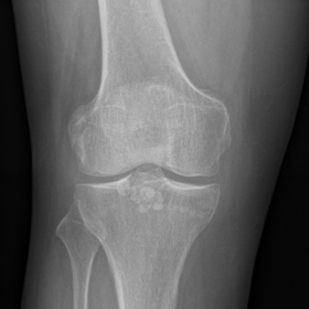Radiographs of both knees
