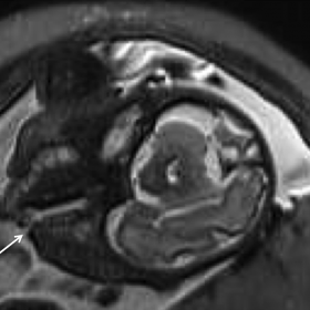 Axial T2-weighted HASTE MRI image