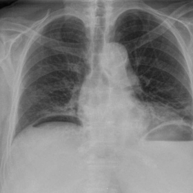 Chest Radiography