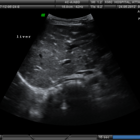 Ultrasound of liver