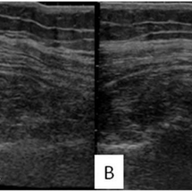 Long axis extended field of view Ultrasonography