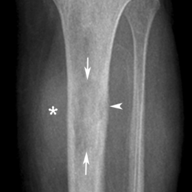 Anteroposterior radiograph of the left proximal tibia and fibula