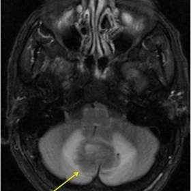 Initial MRI Brain