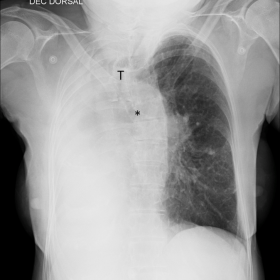 Anteroposterior chest radiograph